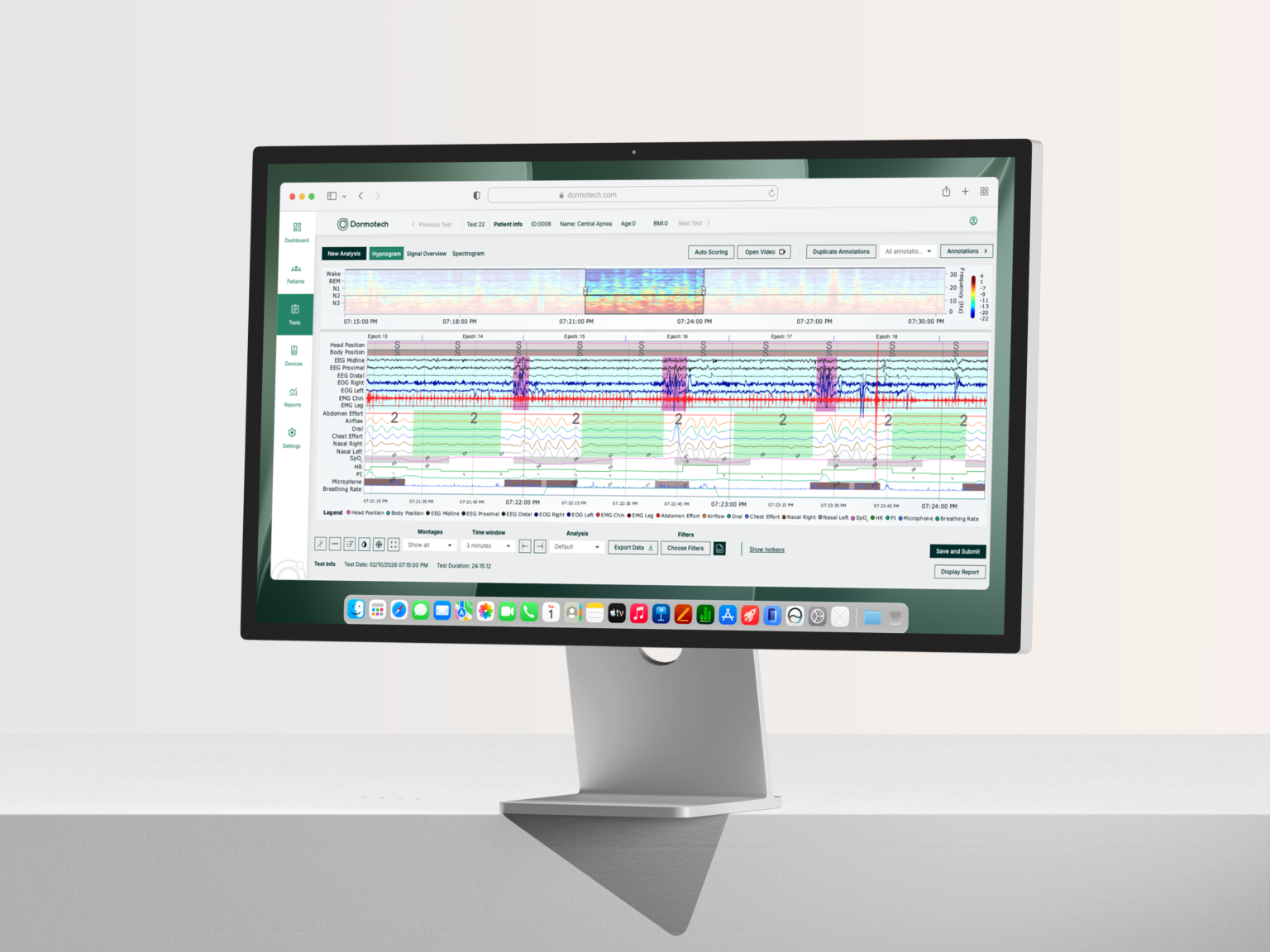 esktop monitor displaying the Dormovision X™ Platform with sleep study data, physiological signal traces, and sleep-stage analysis.